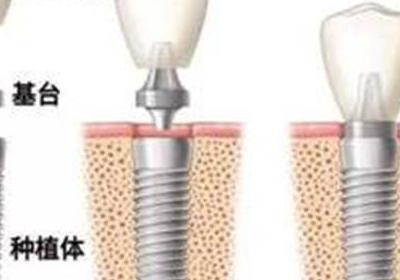 种植牙齿的好处 种植牙齿的优点